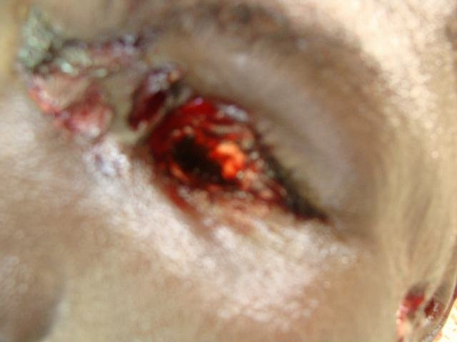 Gunshot Entrance through Eye